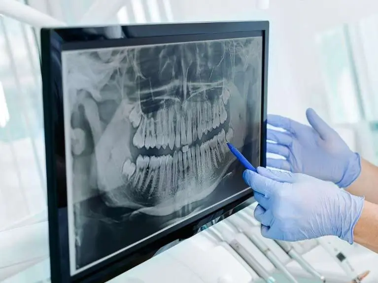 Panoramic X-Rays Img