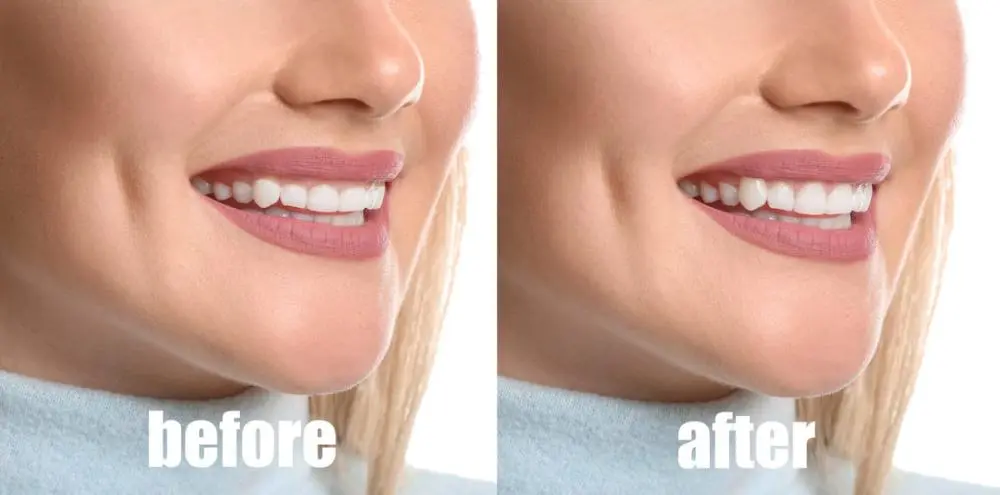 Gum Contouring Image