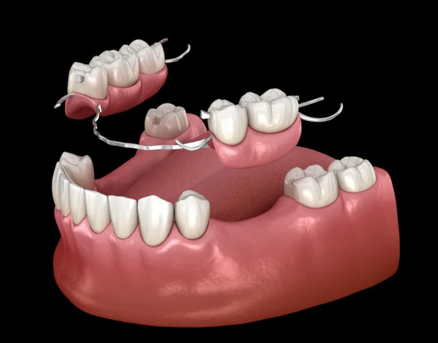 Partial Denture illust